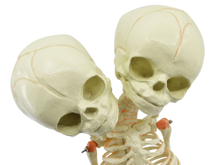 Infant Fetus Skeleton Model, Mini Size - Twin, Conjoined Skull - Rod Mounted