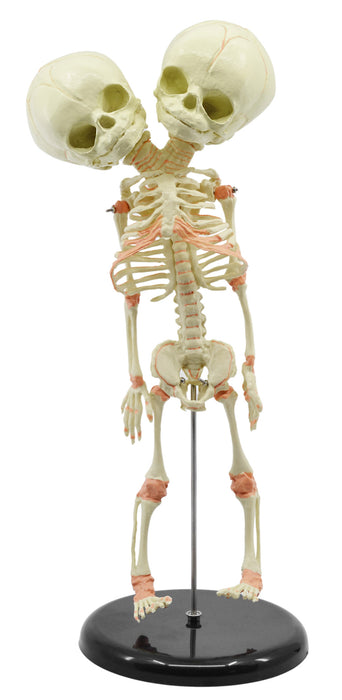 Infant Fetus Skeleton Model, Mini Size - Twin, Conjoined Skull - Rod Mounted